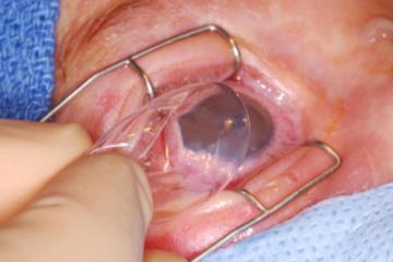Pterygium Surgery