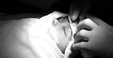 Lacrimal Surgery