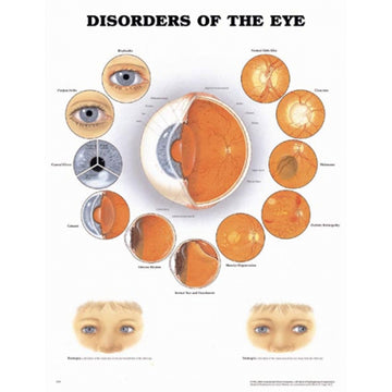 Disorders of Eye Anatomical Chart