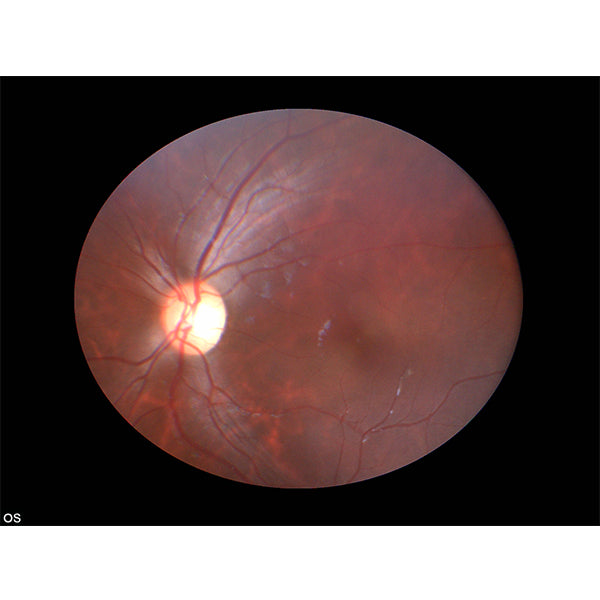 Bosch Hand-held Fundus Camera